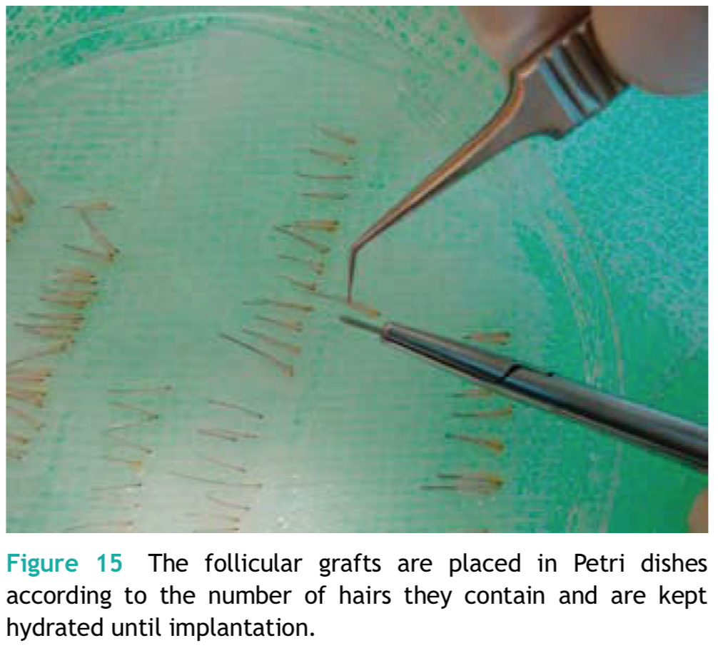 FUT植髮手術分髮過程，將多餘的組織移除